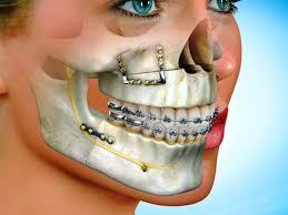 Craniomaxillofacial Fixation CMF Devices market