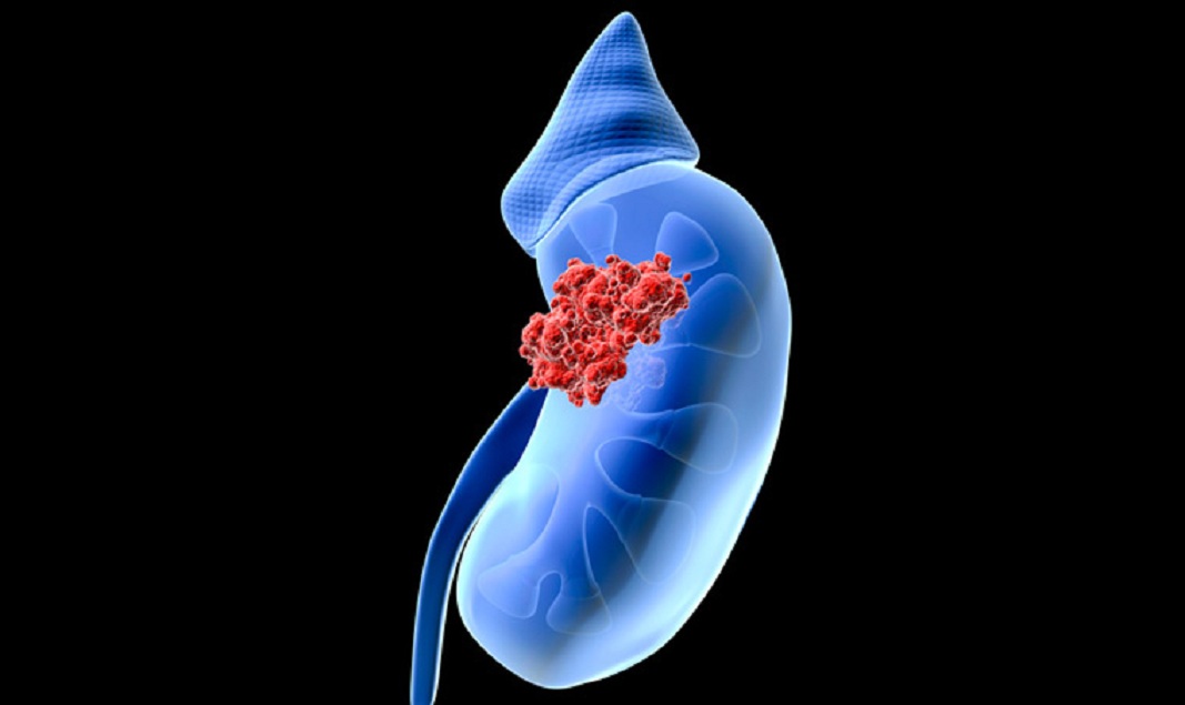 Kidney Cancer Diagnostics and Therapeutics