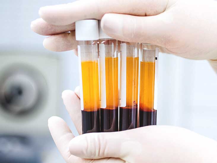 Platelet Rich Plasma (PRP)