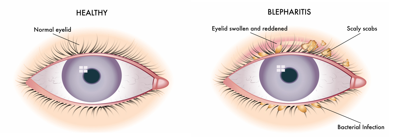 Blepharitis Treatment Market